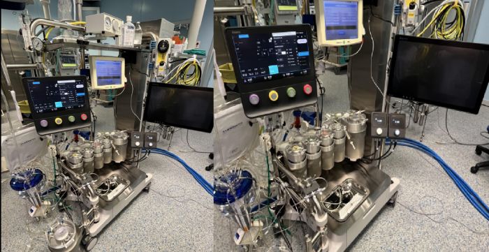 Cardiochirurgia triestina all'avanguardia, macchina cuore-polmone per interventi a cuore aperto”